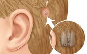 implanted device for the hearing impaired